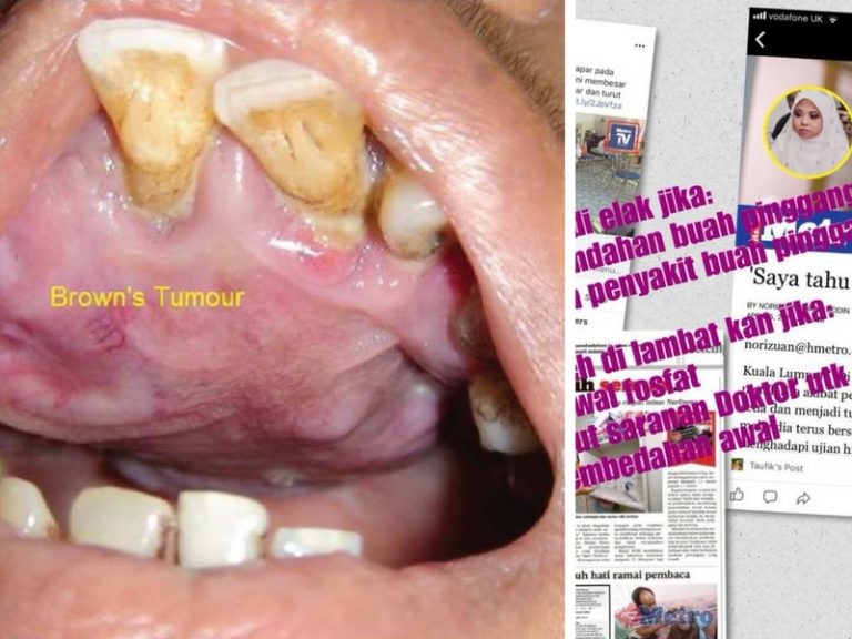 Kontroversi Doktor VS MEDIA SALAH LAPOR, Ini Penyakit Paratiroid Yang Hangat Diperkatakan