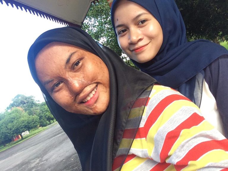 “Tipu Kalau Tak Ada Rasa Sedih Bila Orang Tanya Pasal Muka”, Gadis Disimbah Asid Akui Makin Sukar Bernafas