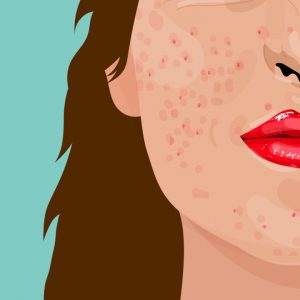 Boleh Picit Jerawat, Tapi STOP Jika Berdepan 4 Perkara Ini - REMAJA