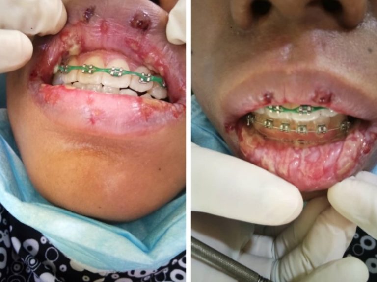 Dr Youtube Vs Pakar Ortodontik, Ini Beza Antara Fake Braces Dengan Ori