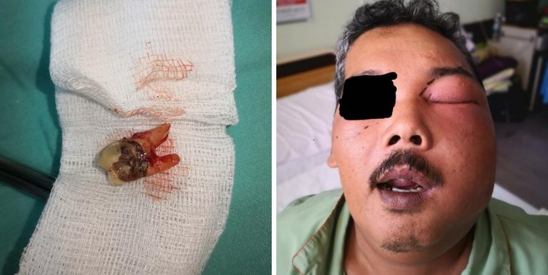 Letak Minyak Brek Motor Pada Gigi, Akibatnya Lelaki Ini Masuk ICU  Muka Penuh Nanah
