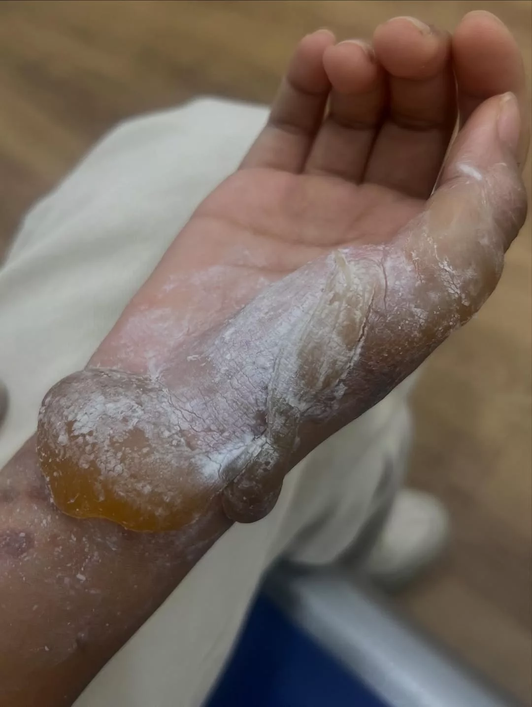 Anak Shuib Cedera Melecur Akibat Minyak Panas, Risau Wajah Jadi Hodoh