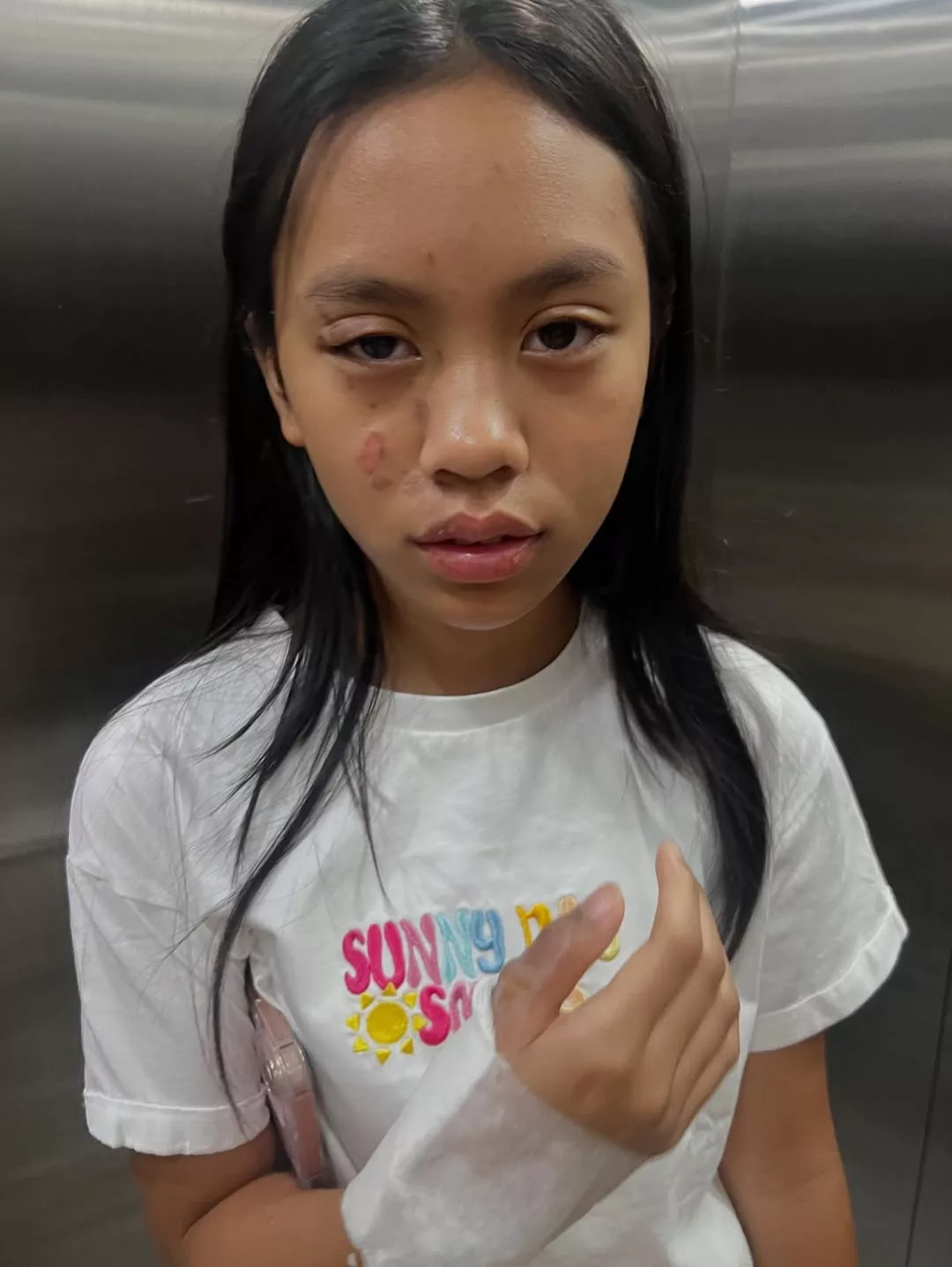 Anak Shuib Cedera Melecur Akibat Minyak Panas, Risau Wajah Jadi Hodoh