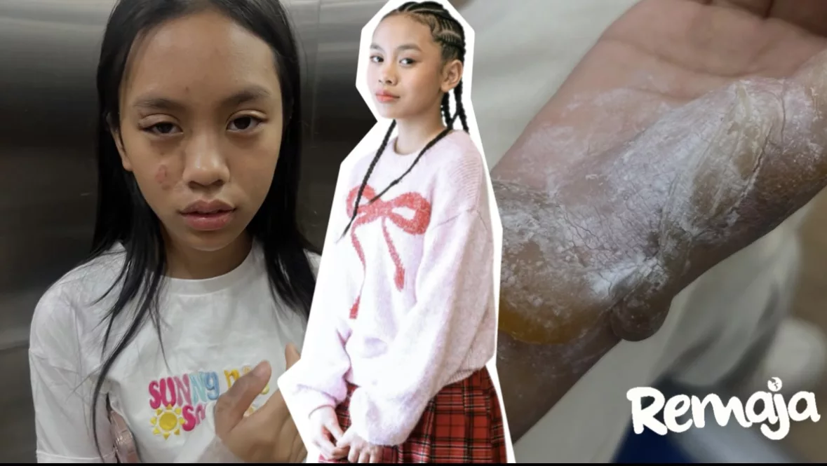 Anak Shuib Cedera Melecur Akibat Minyak Panas, Risau Wajah Jadi Hodoh