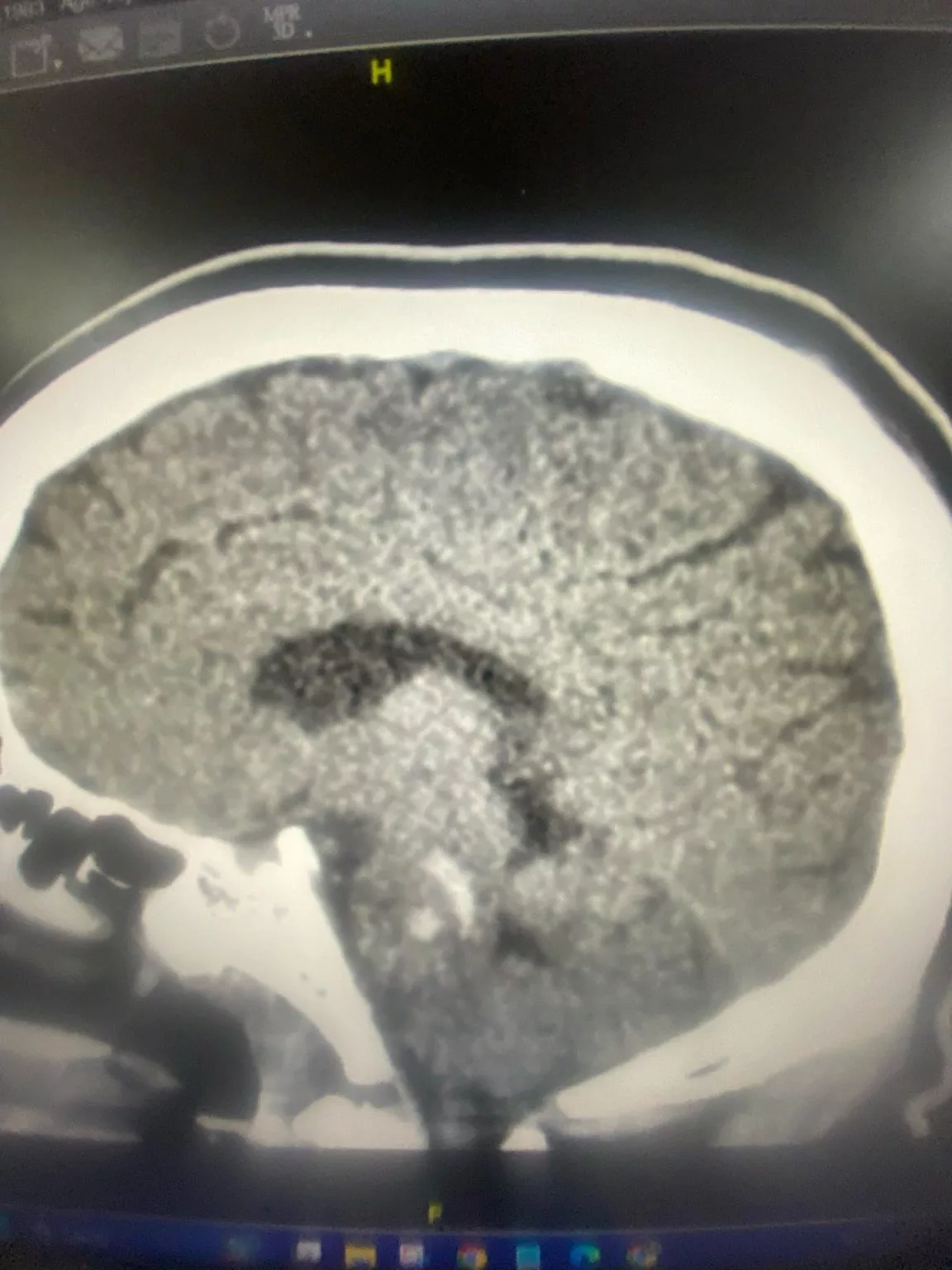 Bukan Lagi Penyakit Orang Tua, Kes Strok &  Pendarahan Dalam Kepala Anak Muda Makin Meningkat