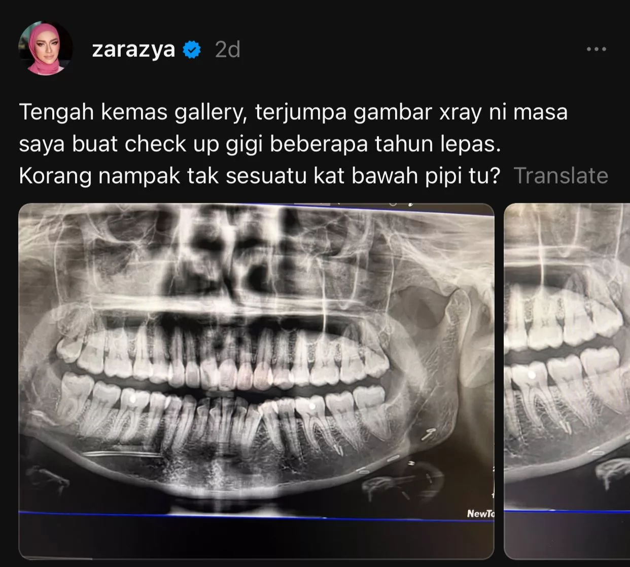 “Ingat Aku Hantu Ke?” Doktor Tuduh Zara Zya Pakai Susuk Gara-Gara Imbasan X-Ray