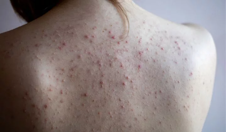 Asid Glikolik Bukan Hanya Untuk Wajah, 4 Manfaat Lain Yang Mengejutkan!