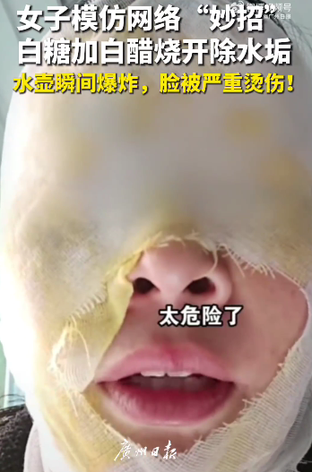Padah Ikut ‘Online Hack’: Wanita Melecur Wajah Lepas Campuran Gula Dan Cuka Meletup!