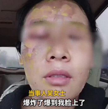 Padah Ikut ‘Online Hack’: Wanita Melecur Wajah Lepas Campuran Gula Dan Cuka Meletup!