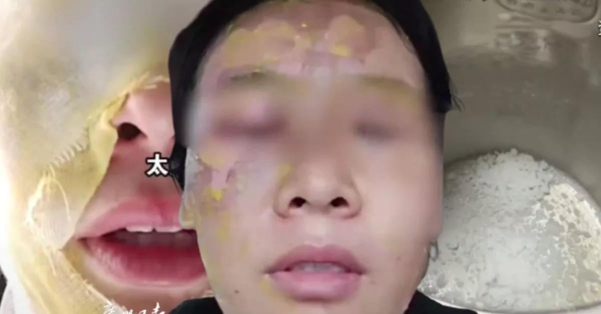 Padah Ikut ‘Online Hack’: Wanita Melecur Wajah Lepas Campuran Gula Dan Cuka Meletup!