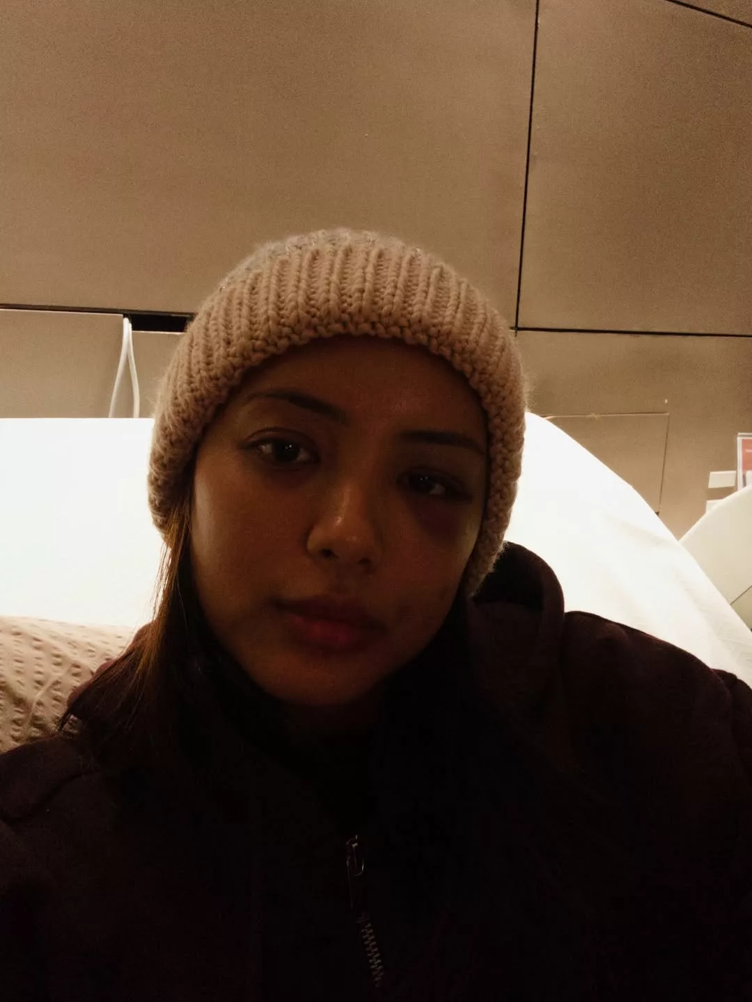 Ezzanie Jasny Kongsi Keadaan Terkini, Masih Alami Bengkak Di Wajah -“Alhamdulillah Kini Semakin Pulih”