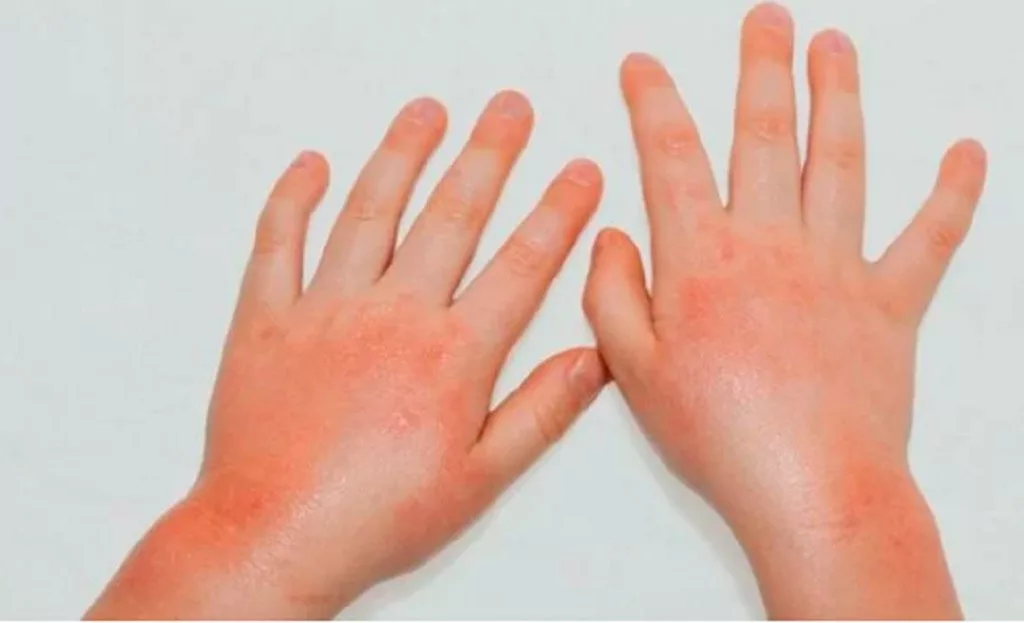 Batuk Lama Tak Kebah? Pesakit Autoimun Kongsi Ubat Batuk Tradisional Berkesan