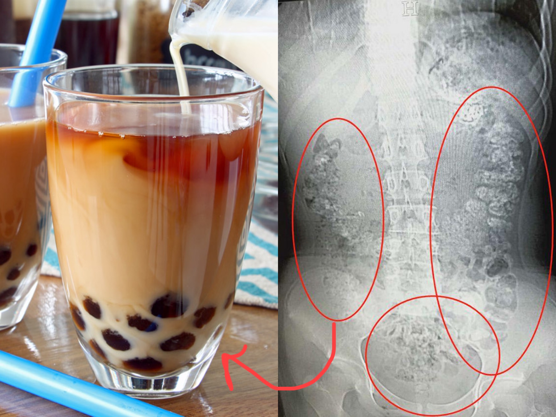 Viral Pearl Minuman Bubble Tea Dalam Usus Remaja, Doktor ...