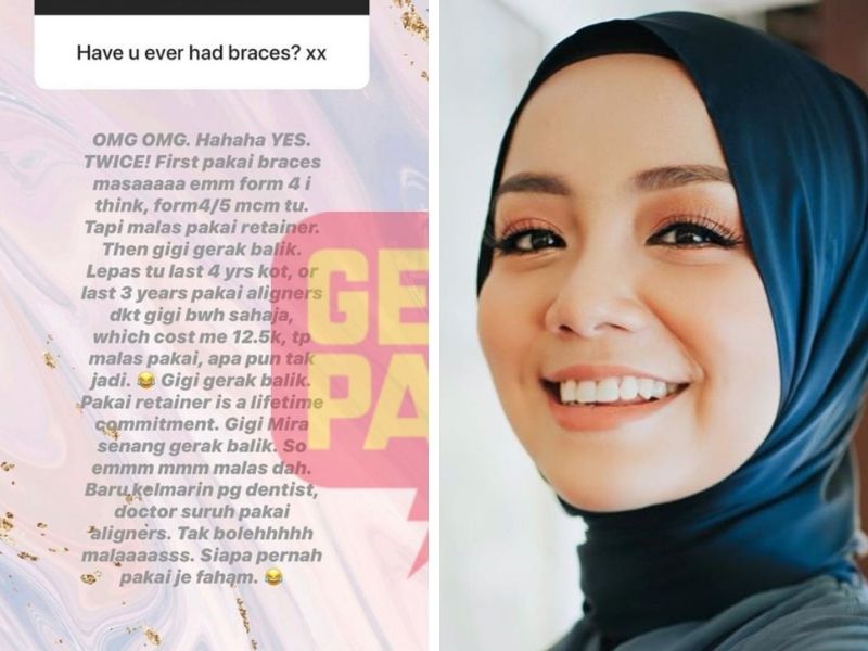 7 Selebriti Yang Pernah Pakai Braces, Hasilnya Kini Gigi Cantik Dan Senyuman Menawan